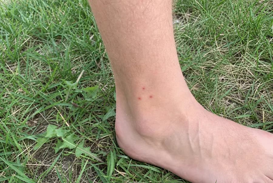 Three small red bite bumps in a cluster just above a person's ankle